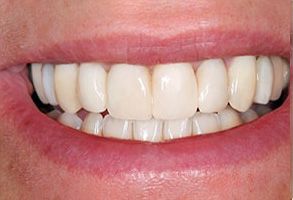 Plum Dental Associates | Extractions, Sports Mouthguards and ViziLite   Plus