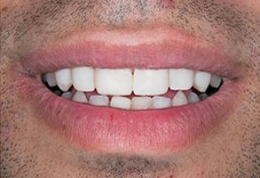 Plum Dental Associates | Dental Cleanings, Ceramic Crowns and Dental Bridges
