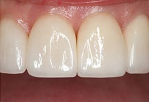 Plum Dental Associates | ViziLite   Plus, Preventative Program and Snoring Appliances