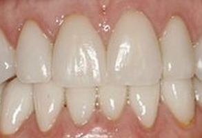 Plum Dental Associates | Dental Bridges, Snoring Appliances and Dental Fillings