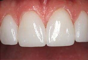 Plum Dental Associates | Invisalign reg , Dental Cleanings and Extractions