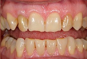 Plum Dental Associates | Dental Fillings, Ceramic Crowns and Colgate reg  Whitening