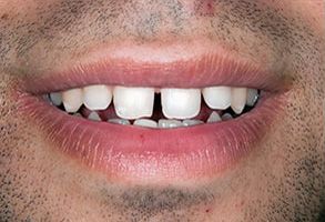 Plum Dental Associates | Veneers, Ceramic Crowns and Preventative Program