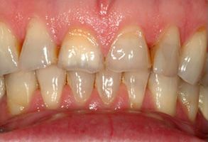 Plum Dental Associates | Dental Bridges, Oral Cancer Screening and Implant Crowns