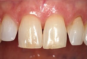 Plum Dental Associates | Sports Mouthguards, Root Canals and Digital Radiography