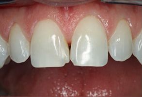 Plum Dental Associates | Sports Mouthguards, Preventative Program and Colgate reg  Whitening